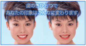 ホワイトニング比較